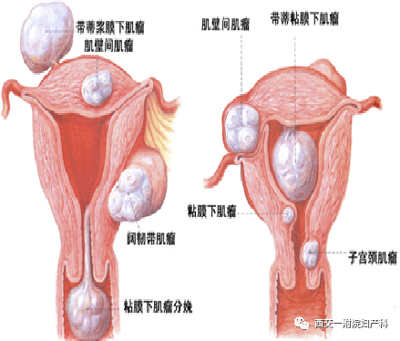 肌瘤最早进展及其相关研究进展探究
