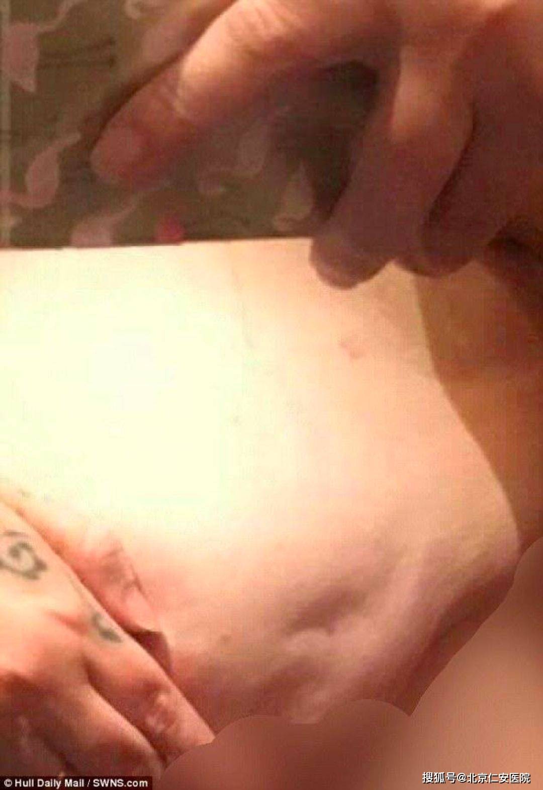 印度新冠疫情首次通报，早期挑战与应对策略的探讨