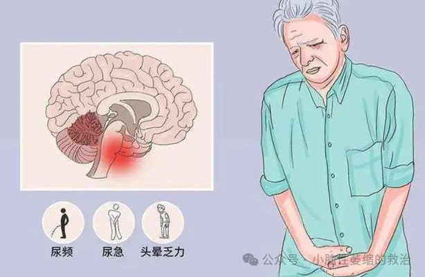 小脑萎缩的早期治疗进展研究